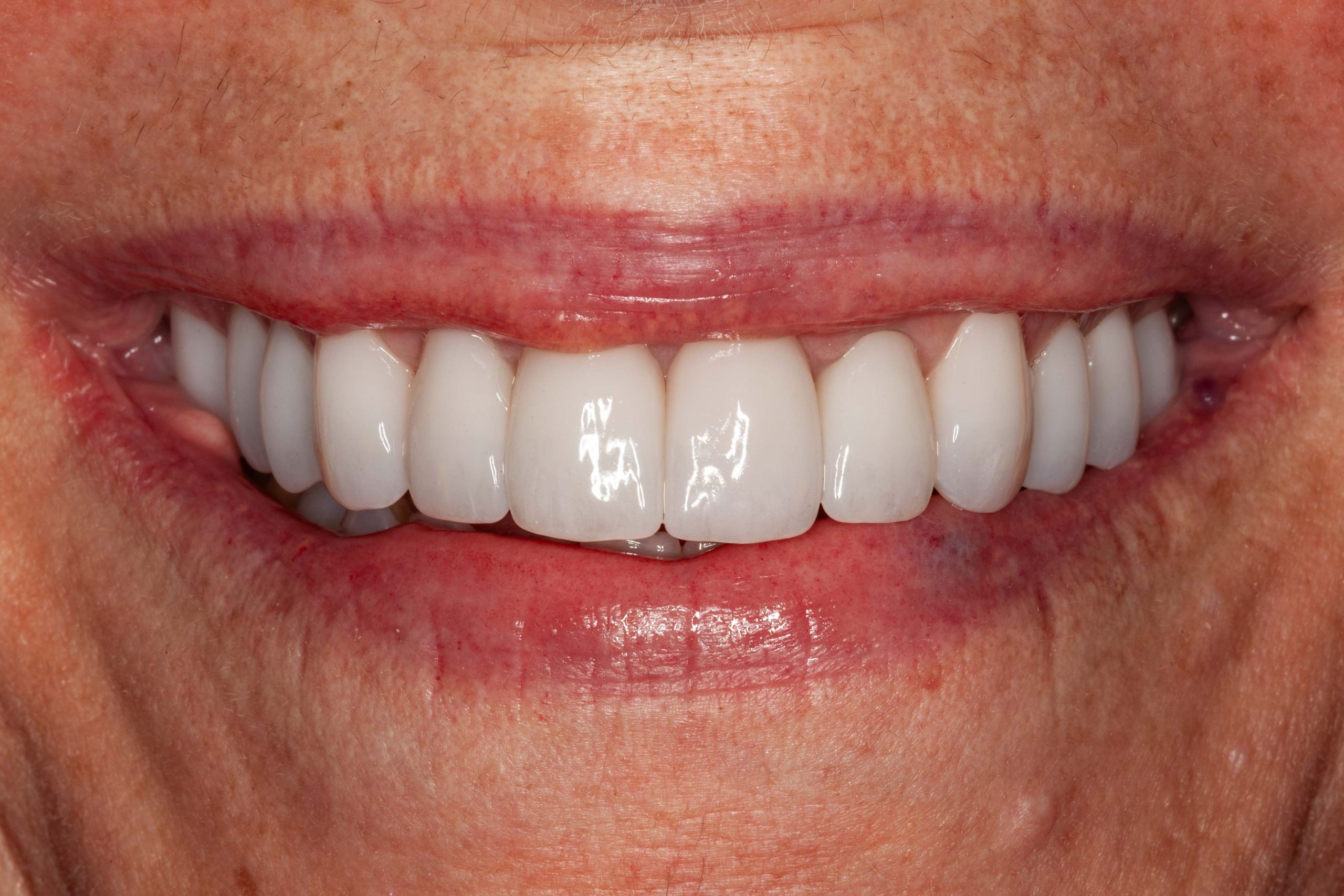 G.B. - Upper Crowns and Ortho After G.B. - Upper Crowns and Ortho After